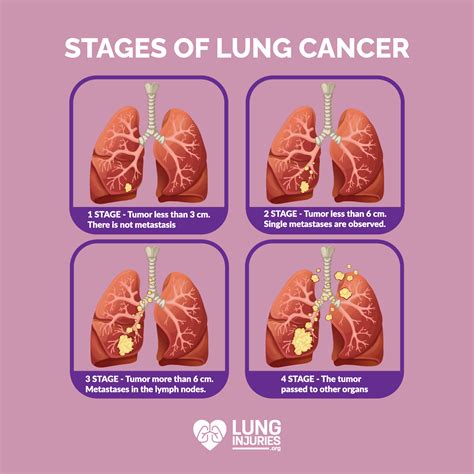 stage 4 melanoma lung cancer